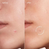 Invisible pimple and acne patches from Maree&
