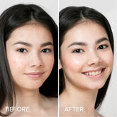 Maree pimple and acne patches on skin, showing clear, small transparent patches designed to treat blemishes and acne spots.