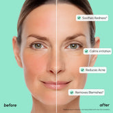 Maree Redness Soothing Azelaic Acid Serum in a clear bottle with dropper, designed to reduce redness and calm skin.