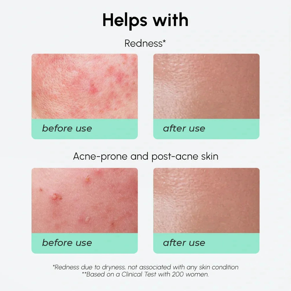 Maree Redness Soothing Azelaic Acid Serum in a clear dropper bottle, designed to reduce redness and calm sensitive skin.
