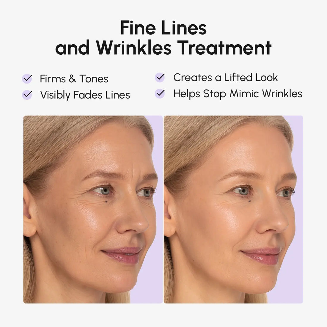 Maree anti-wrinkle tape patches applied around eyes and forehead for reducing fine lines and smoothing skin.