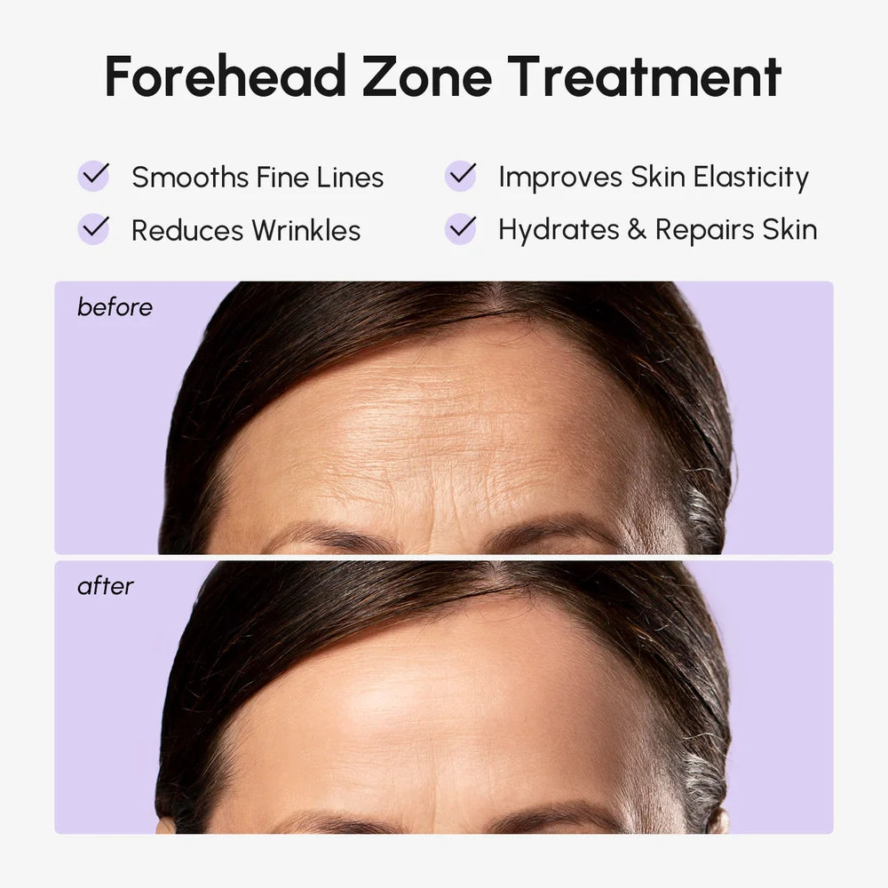 Maree Anti-Wrinkle Forehead Patches applied on forehead for reducing lines and smoothing skin appearance.