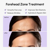 Maree Anti-Wrinkle Forehead Patches applied on forehead for reducing lines and smoothing skin appearance.