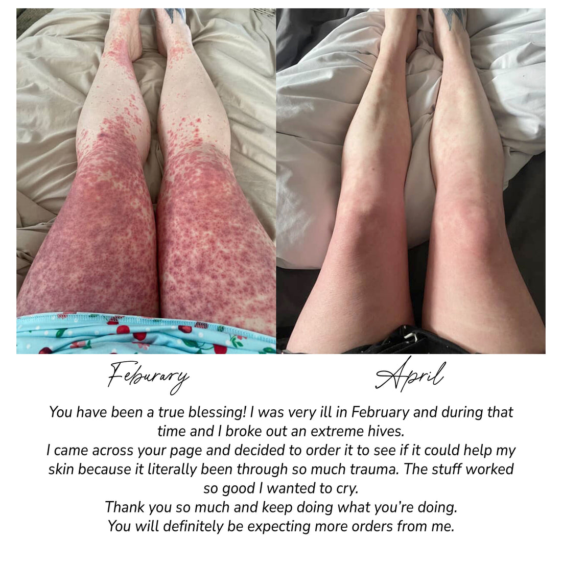 Before and after images showing Pretty Farm Girl fragrance-free tallow and honey cream applied to sensitive skin.